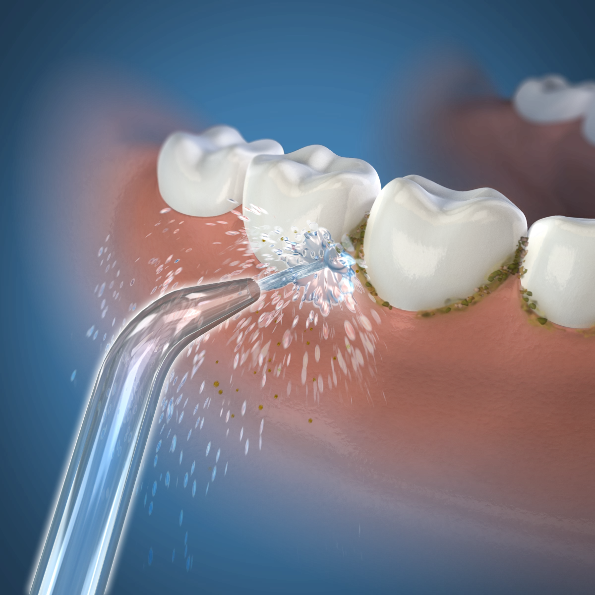 Waterpik Classic Jet replacement nozzles, 2 pcs